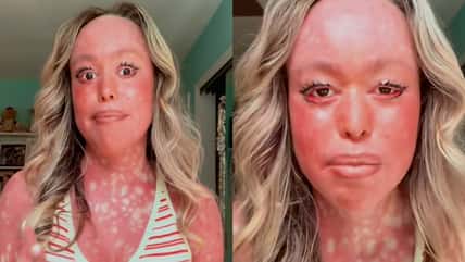 She Has Ichthyosis Confetti, A Rare Genetic Skin Disorder, And She’s Opening Up About What It’s Like